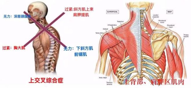 含胸驼背怎么办？这套动作帮你增强上背及颈肩部肌肉力米乐官方平台量(图1)