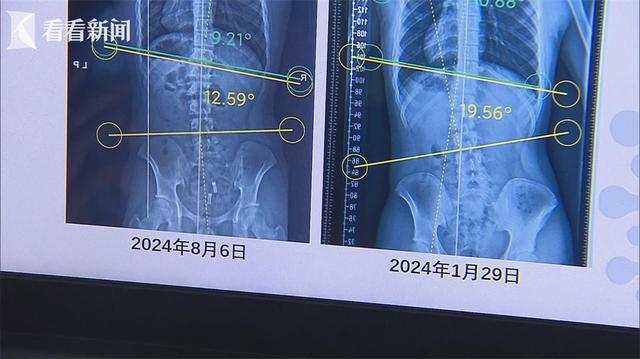 “运动米乐·M6下载是良医” 科学健身改善脊柱侧弯(图3)