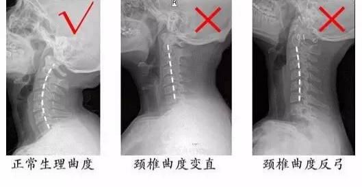 家长注意！坐完过山车脖子竟然米乐·M6下载歪了！(图1)